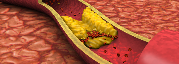 Colesterol alto (LDLHDL) Quando procurar um cardiologista para cuidar do seu coração